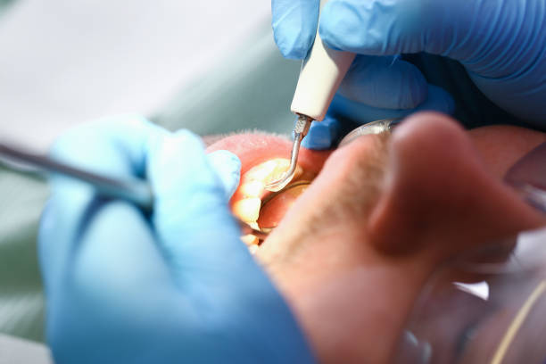 Best Emergency Tooth Extraction in Hurley, MS